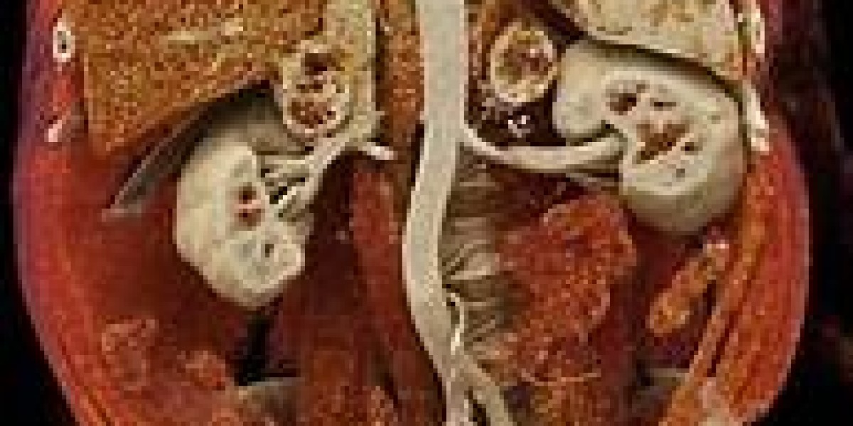 Global Metastatic Renal Cell Carcinoma Market Size and Forecast