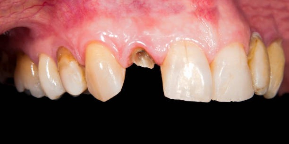 Advanced Dental Care Options for Tooth Fractures in Pakistan