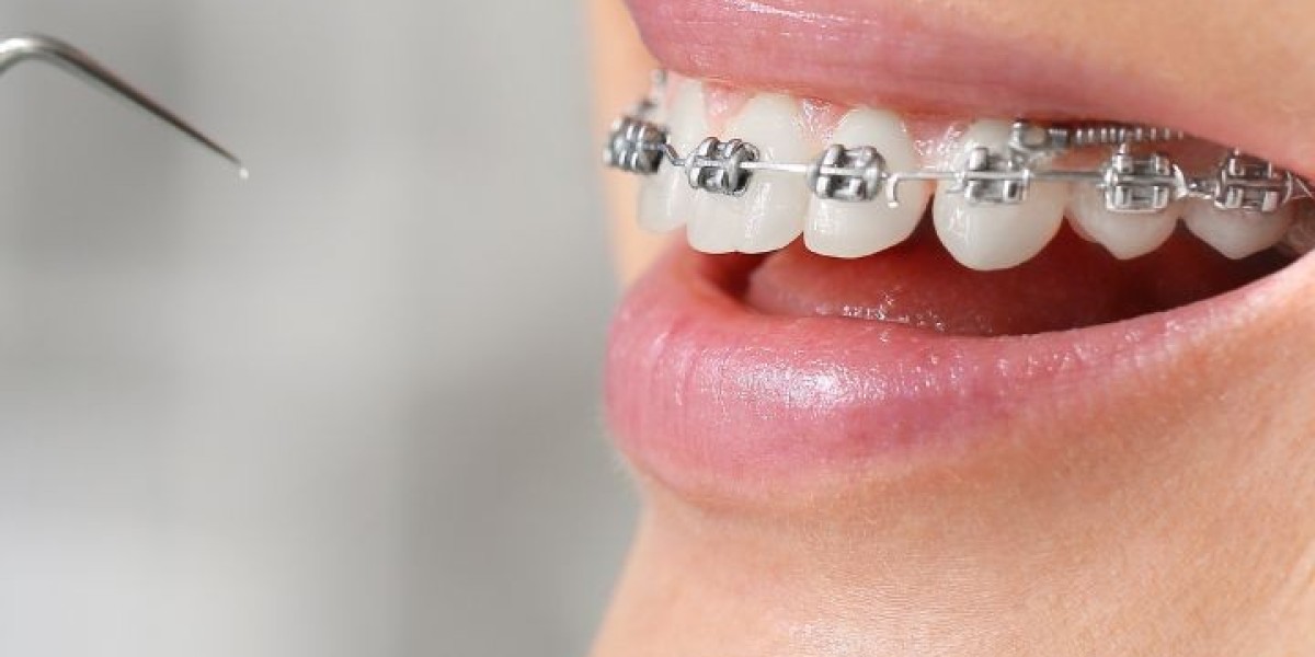 Step-by-Step Guide to Understanding Braces Cost in Australia