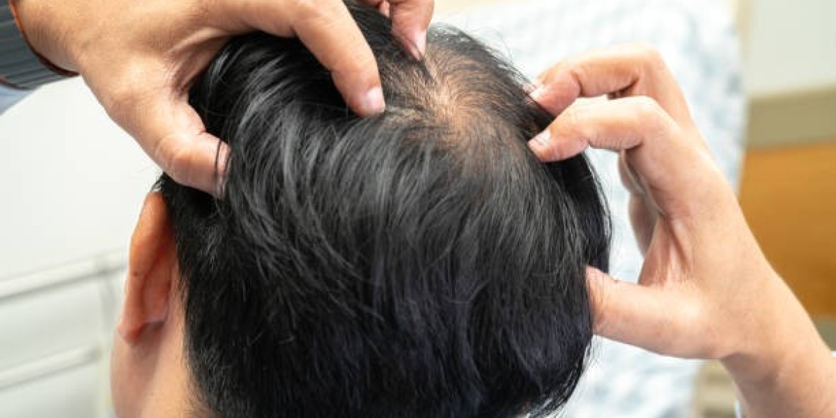 Exosome Therapy For Hair Loss And Natural Hair Rejuvenation Through Cellular Repair