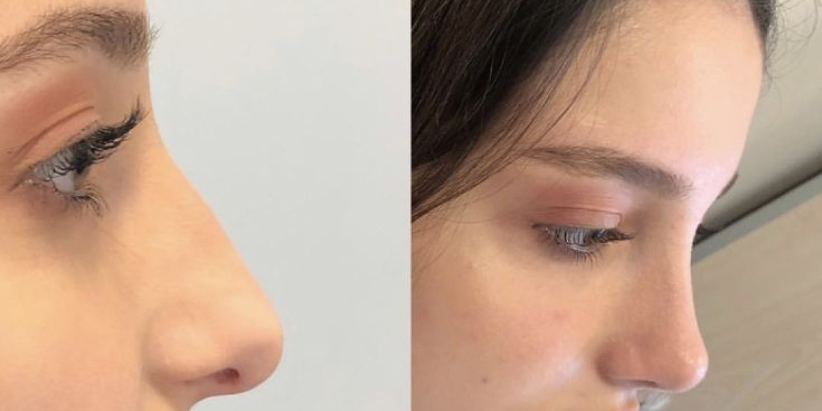 Rhinoplasty in Dubai Surgical Options Overview