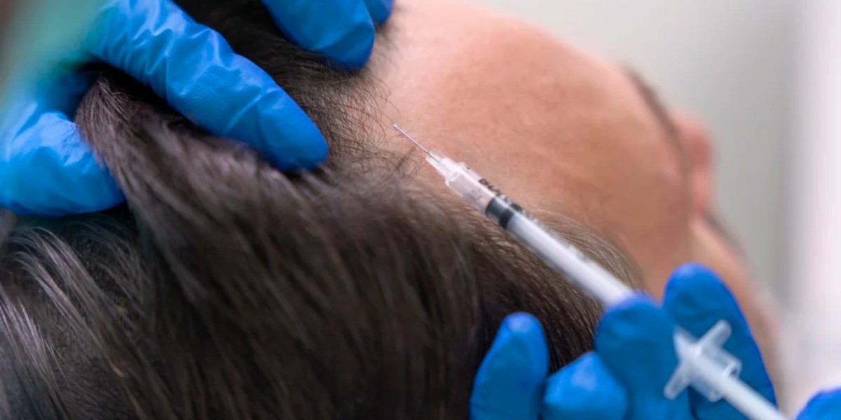 GFC Hair Treatment for Receding Hairline Improvement
