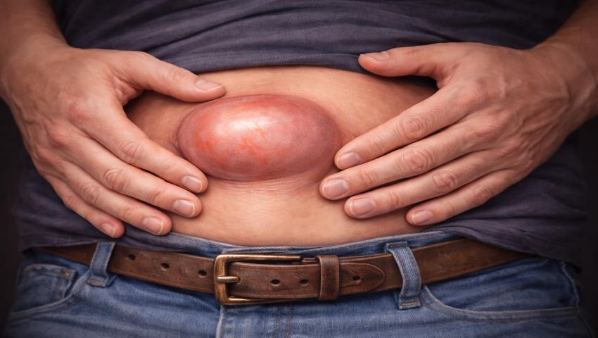Dr. Pinak Dasgupta – Leading Hernia Specialist in Chennai, India