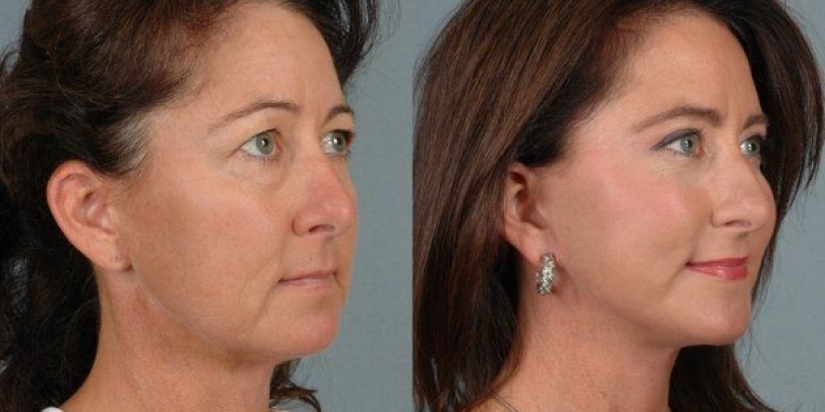 8-point Facelift in Dubai Facial Rejuvenation Trends Guide