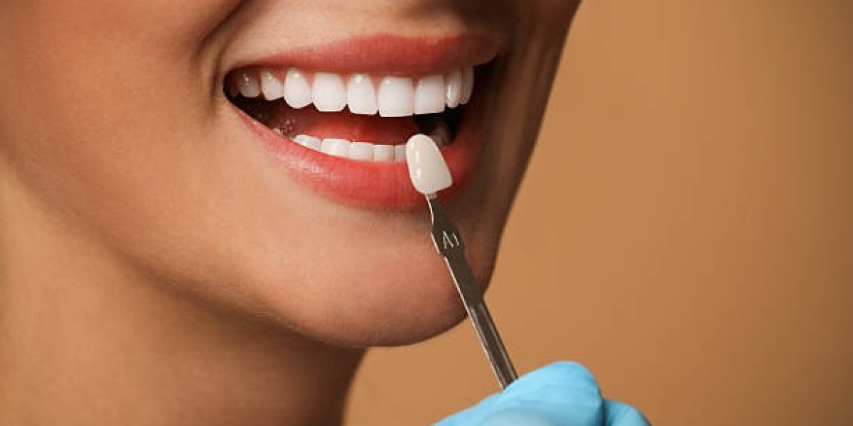 A Trusted Solution for Smile Makeovers Dental Veneers in Pakistan: