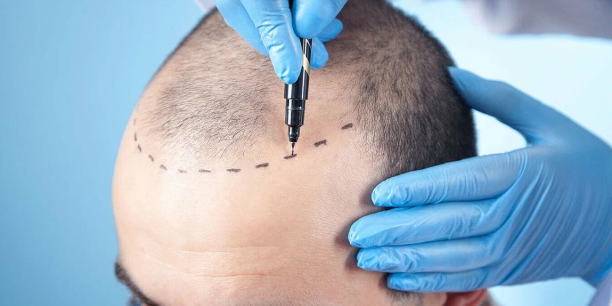 Age considerations for undergoing hair transplant surgery