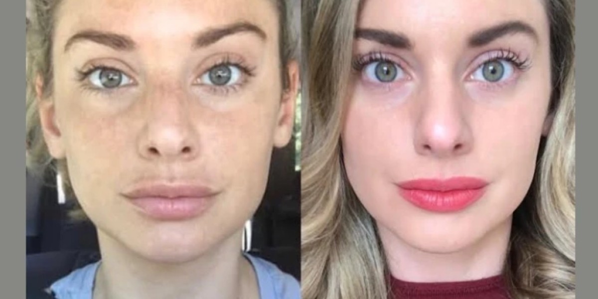 Experience Excellence with Best Plastic Surgeon in Dubai RF Microneedling