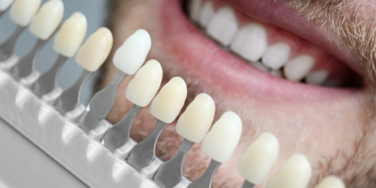 Porcelain Veneers Cost Guide for Australian Smiles