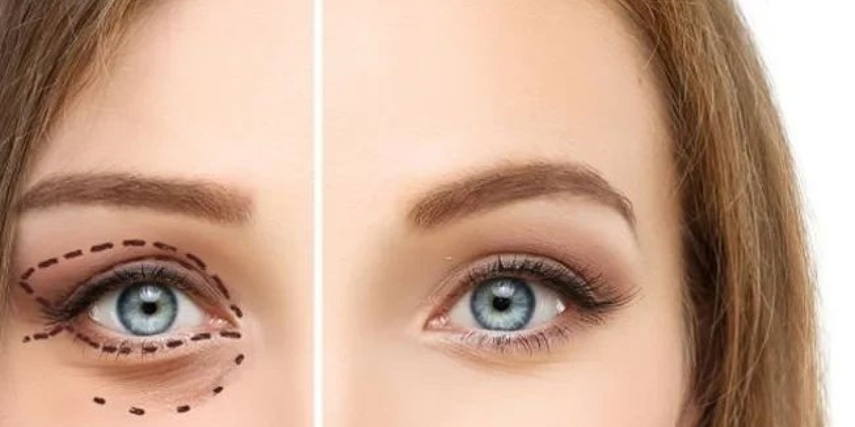 Everything You Should Understand About Eyelid Lift Surgery Today