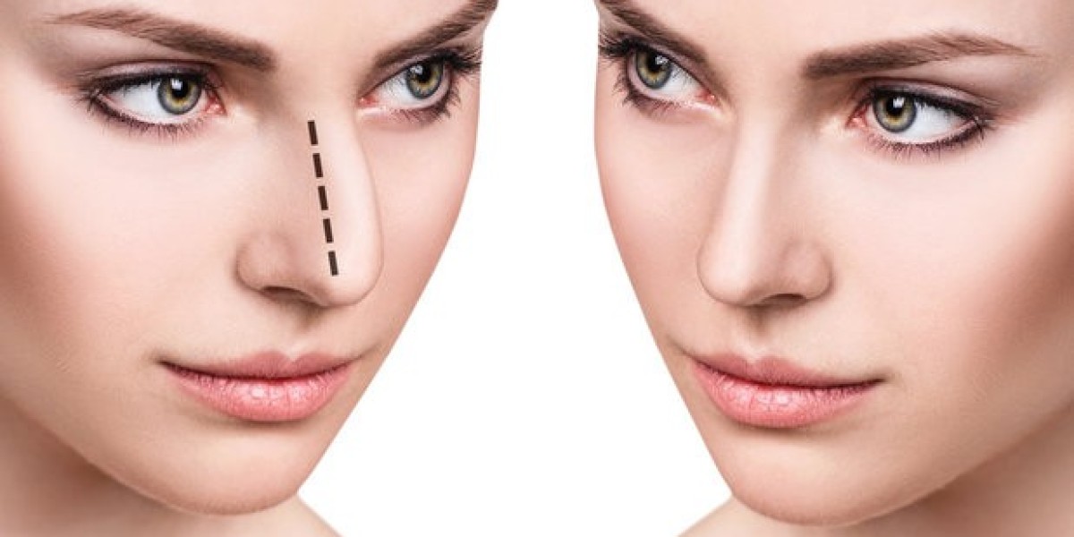 Revision Rhinoplasty in Riyadh: Correcting Past Procedures with Precision