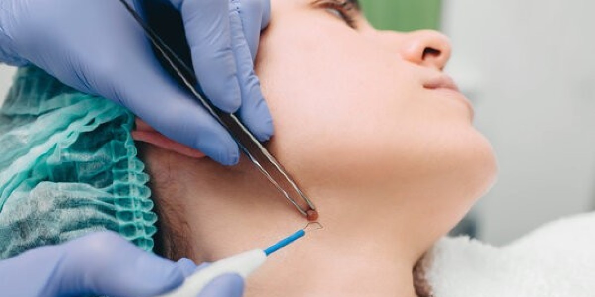 Mole Removal in Dubai: Is It Safe and Effective