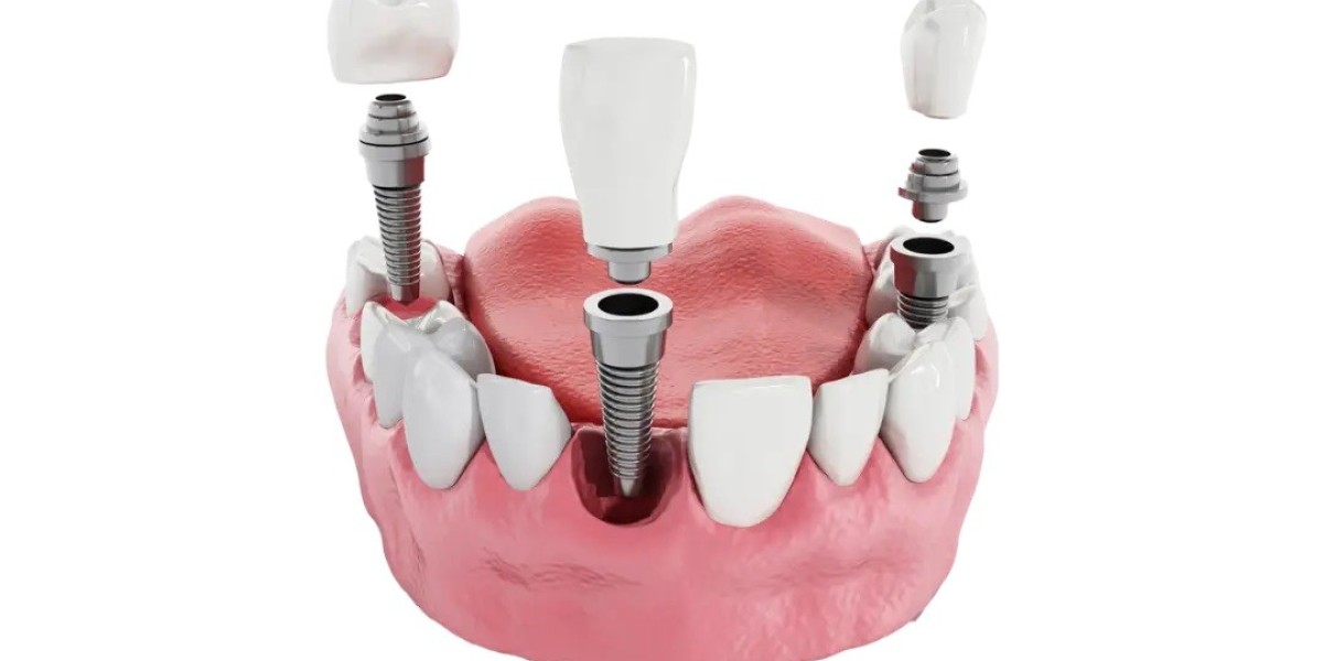 Fix Tooth Loss Problems With Dental Implants Brisbane