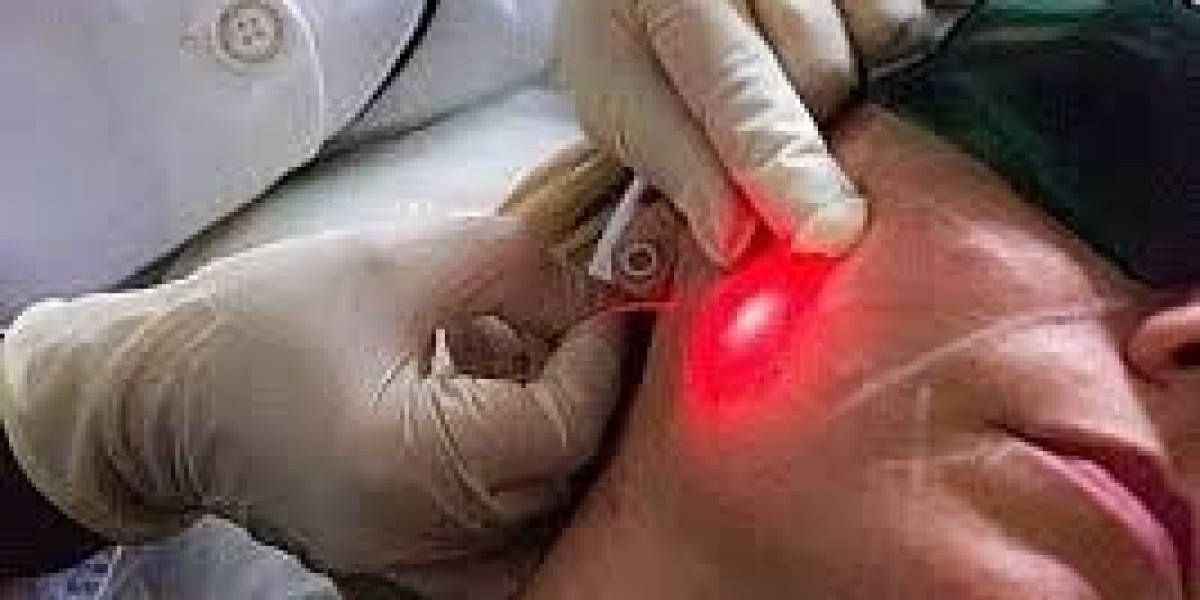 Endolift Treatment in Dubai for Facial Rejuvenation