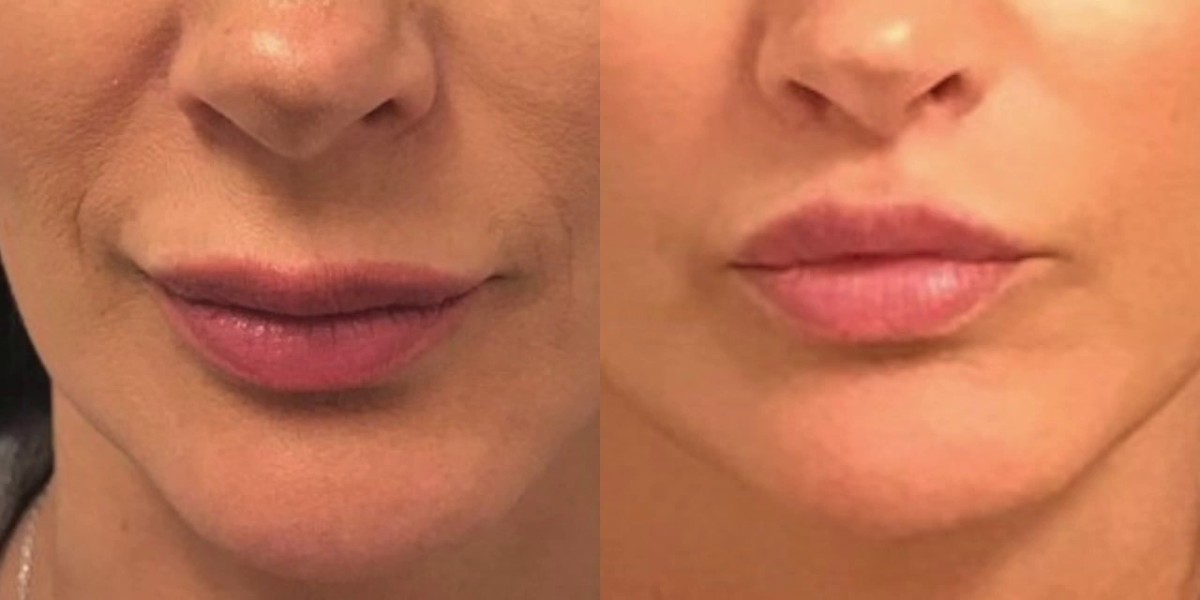 The Evolution of Lip Aesthetics From Volume to Structural Lift