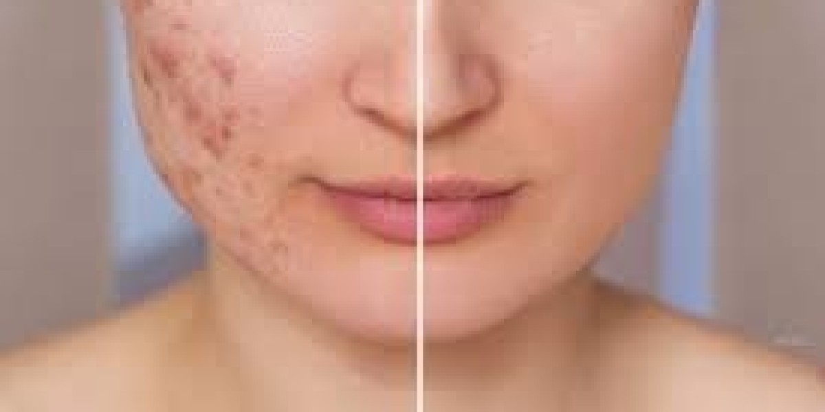 Best Scar Removal in Dubai for Clear Skin & Renewal