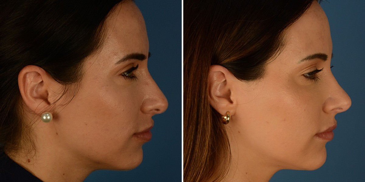 Rhinoplasty in Dubai: Confidence Starts with Balance