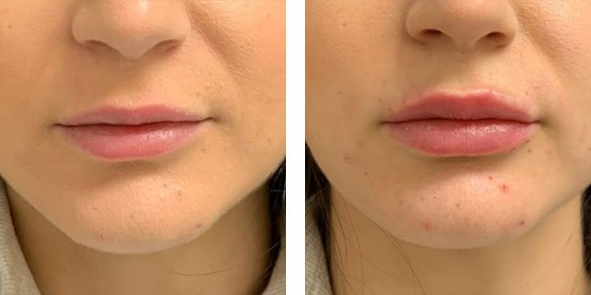 Choosing the Best Lip Filler Clinic in Riyadh: A Patient’s Checklist