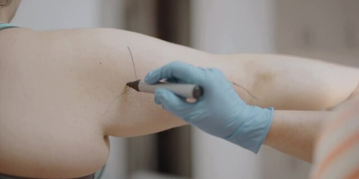Arm Lift Surgery in Dubai for Improved Body Proportion