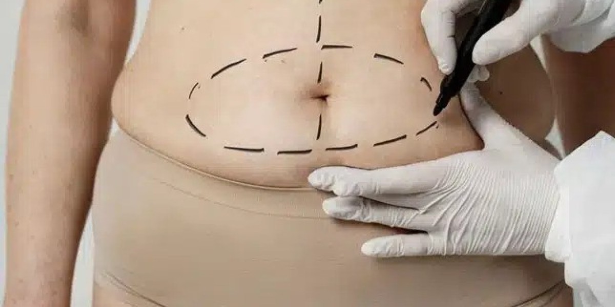 Tummy Tuck in Dubai: Real Patient Experiences