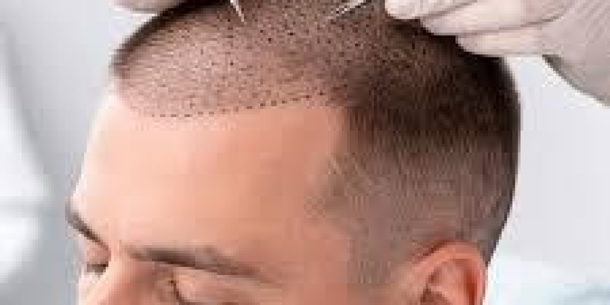 How can a hair transplant improve hairline definition beautifully?