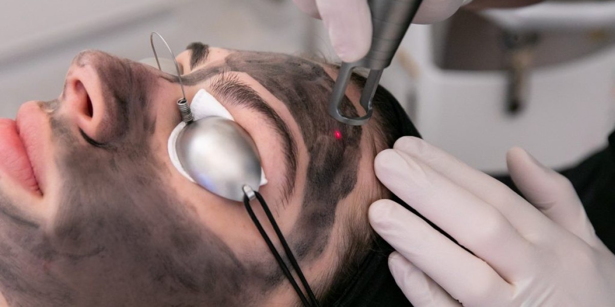 Carbon Laser Peeling Treatment for Instant Skin Glow Results