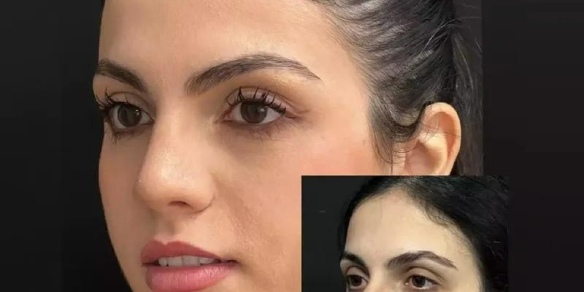 Rhinoplasty in Dubai: Common Nose Correction Guide