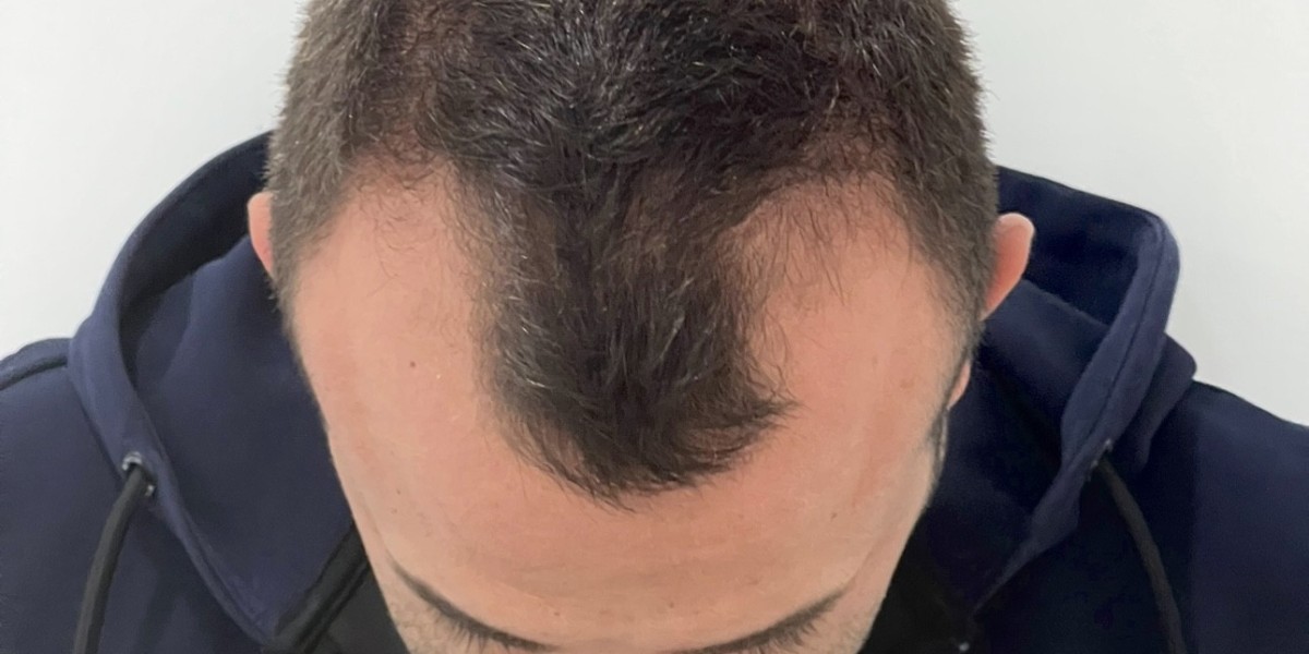 Hair Transplant in Dubai Minimal Downtime Procedure Guide