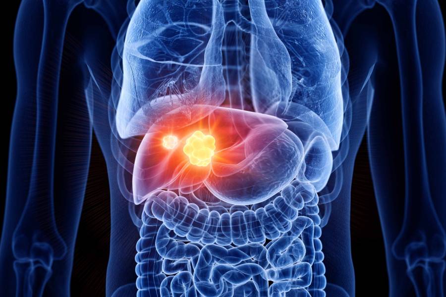 Liver Cancer Surgeon in Chennai | Dr. S. Srivatsan Gurumurthy - GI Cancer Surgeon in Chennai