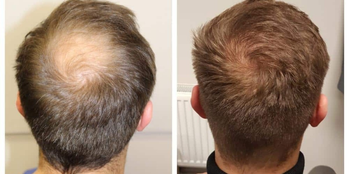 Hair Transplant in Dubai for Receding Hairline Fix