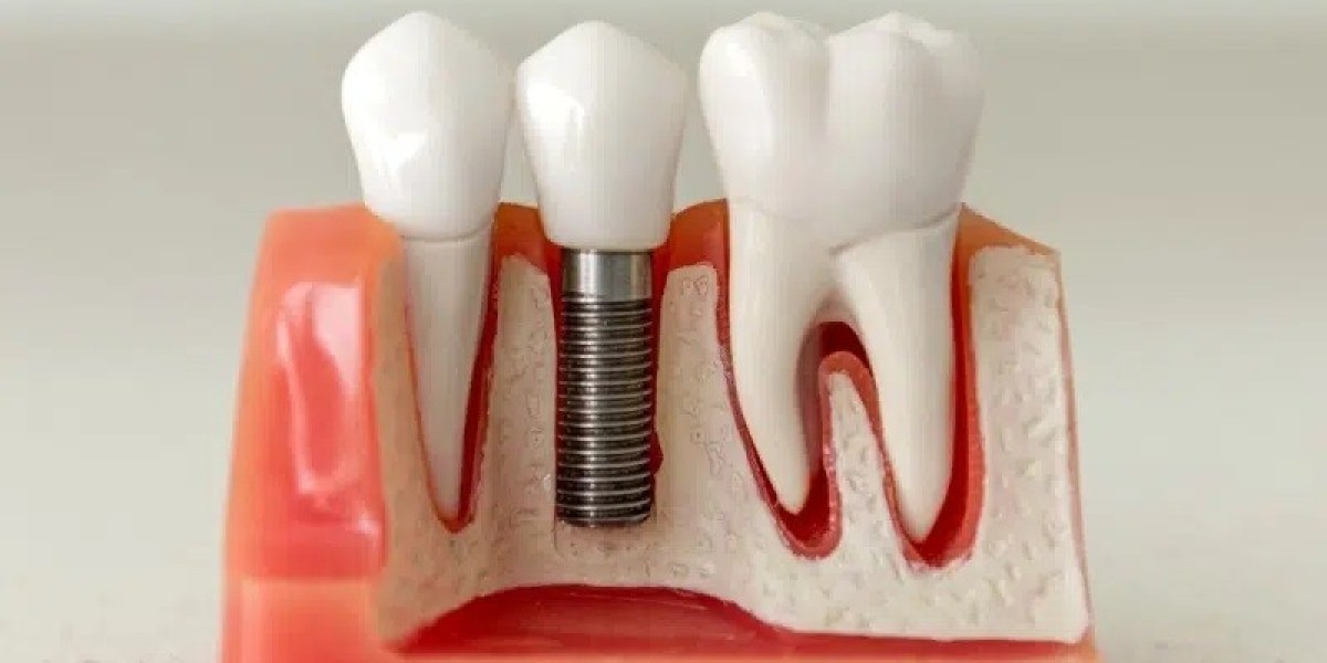 A Beginner’s Guide to Dental Implants in Perth