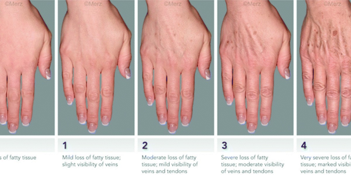 Liquid Hand Lift vs. Laser: Exploring Hand Rejuvenation Options in Riyadh