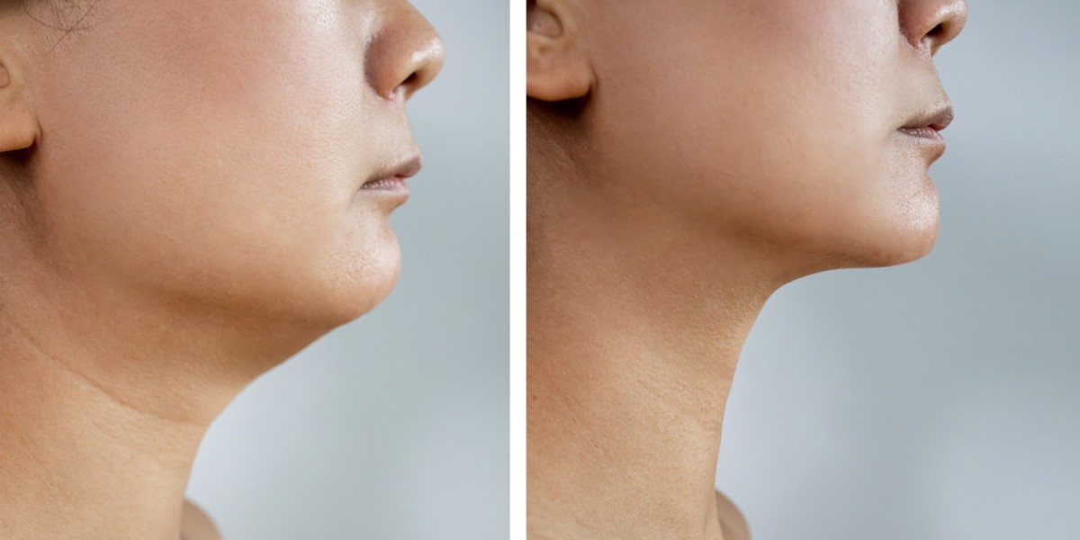 Investing in Your Face: The Lasting Benefits of Chin Refinement