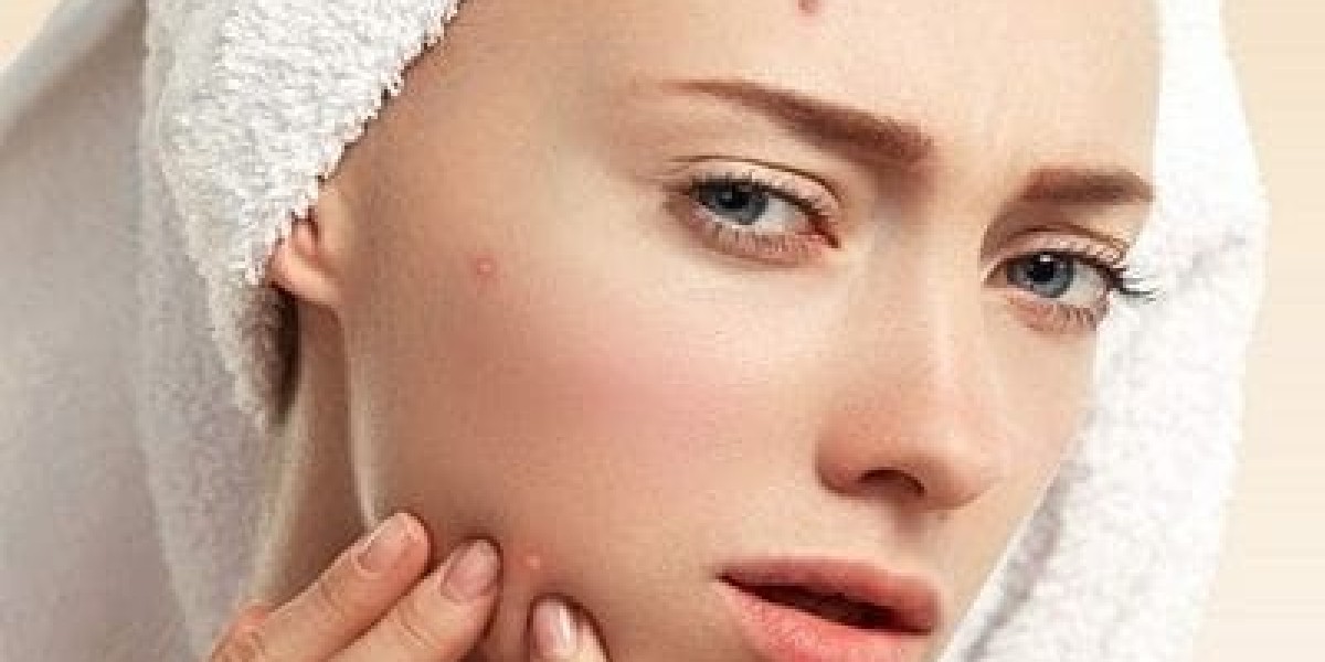 Pimple Treatment in Islamabad for Oily Skin