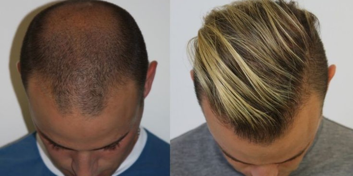 Hair Transplant in Dubai for Hair Loss Treatment Solutions