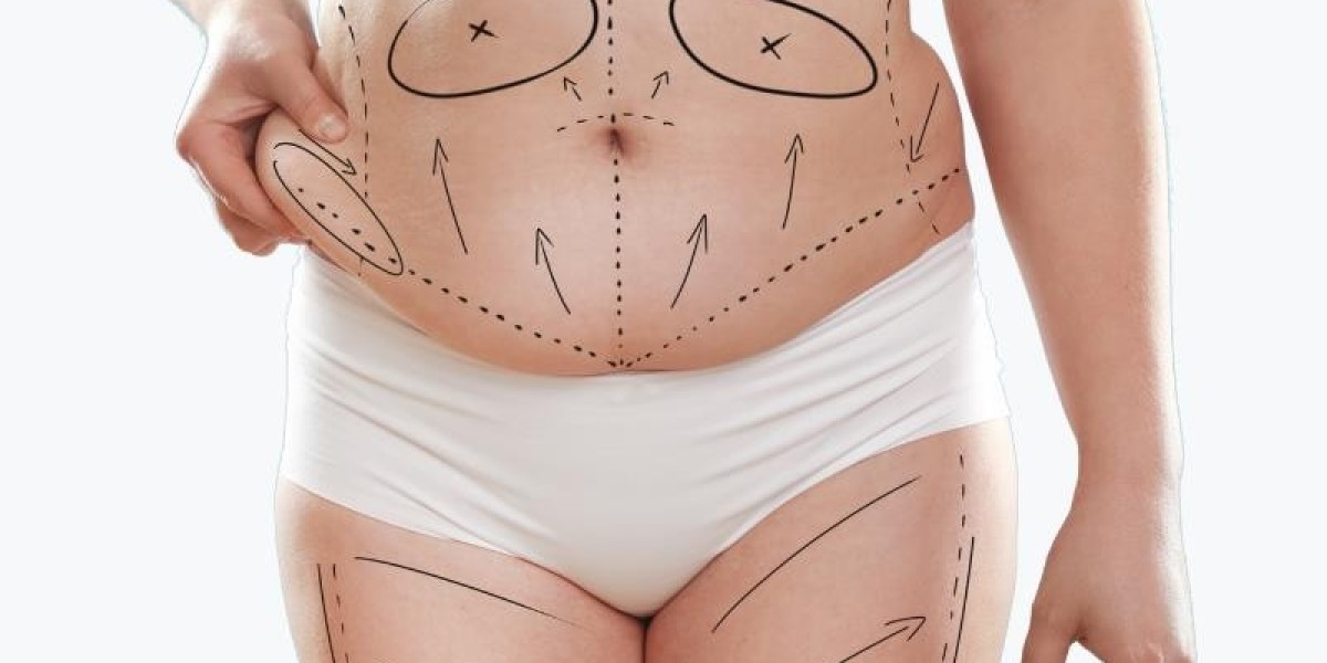 Why Tummy Tuck Is Popular Among Mothers