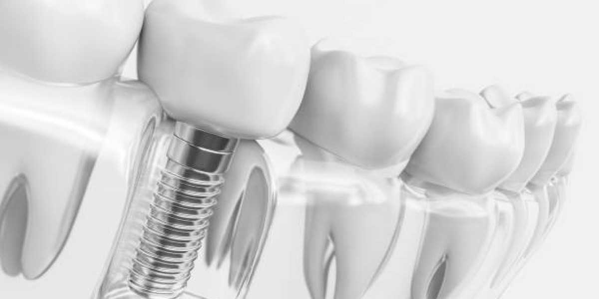Are Dental Implants Melbourne Clinics Affordable?
