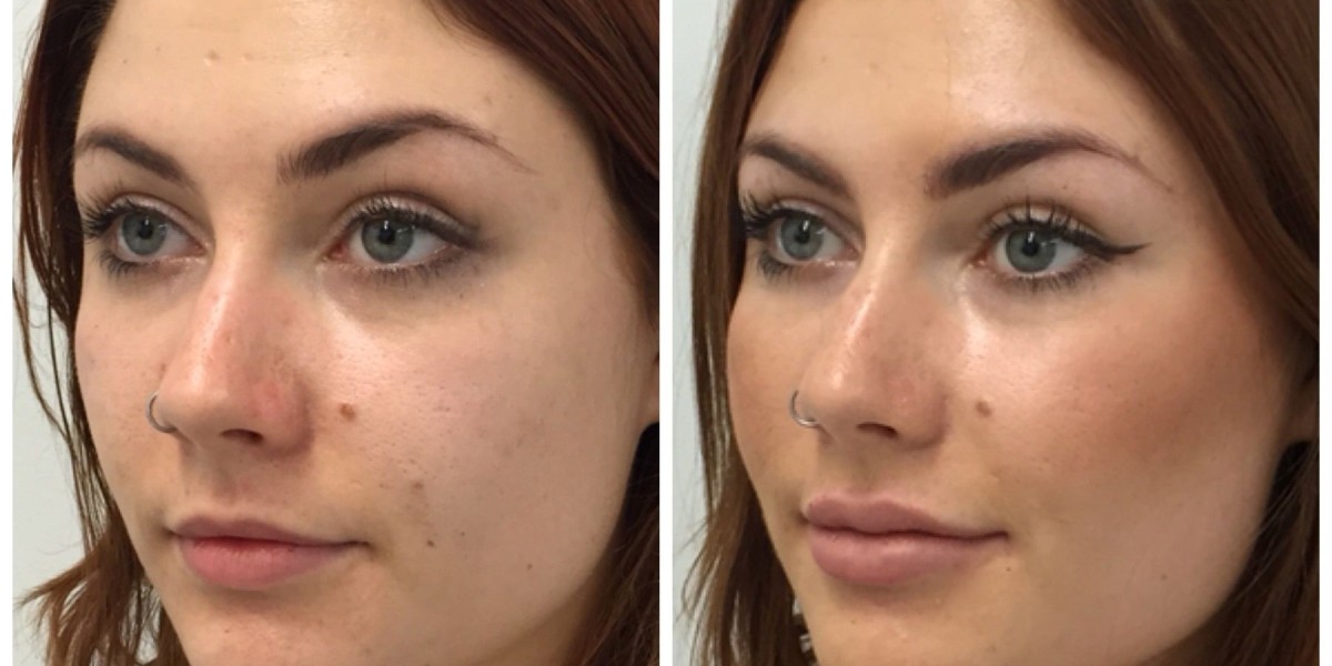 Defining Your Profile: The Rise of Jawline Contouring in Riyadh