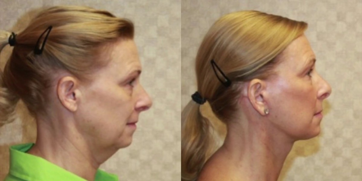 Neck Lift Surgery in Dubai and Skin Tightening
