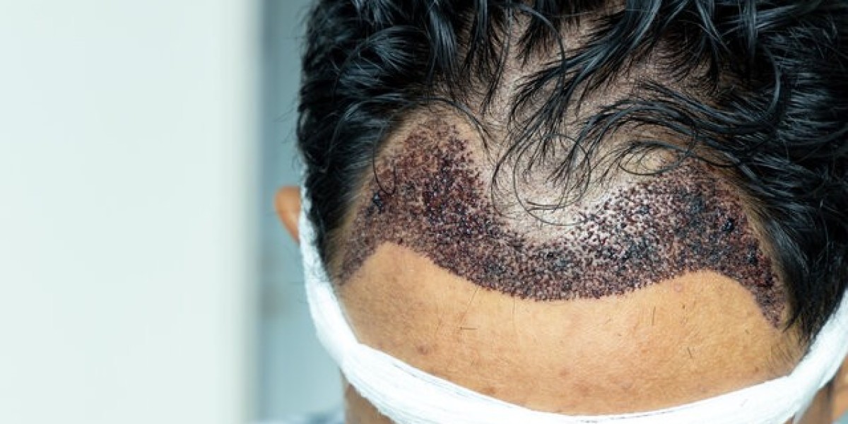 Hair Transplant Cost in Dubai for Thinning Hair Solutions