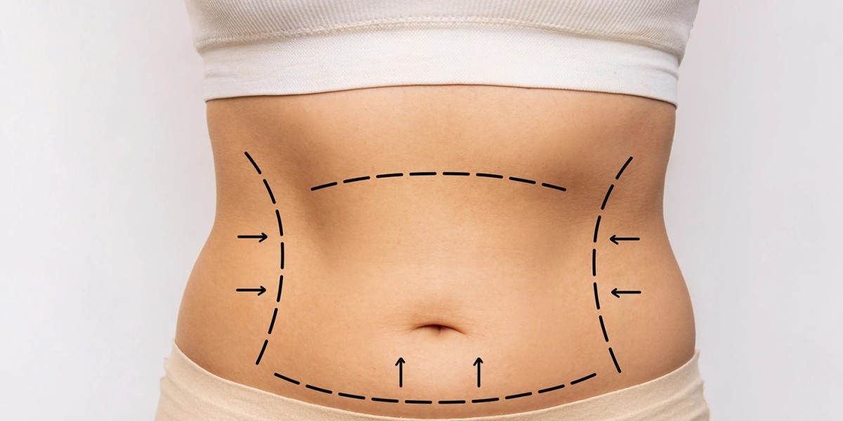 Tummy tuck and scar healing tips for better recovery