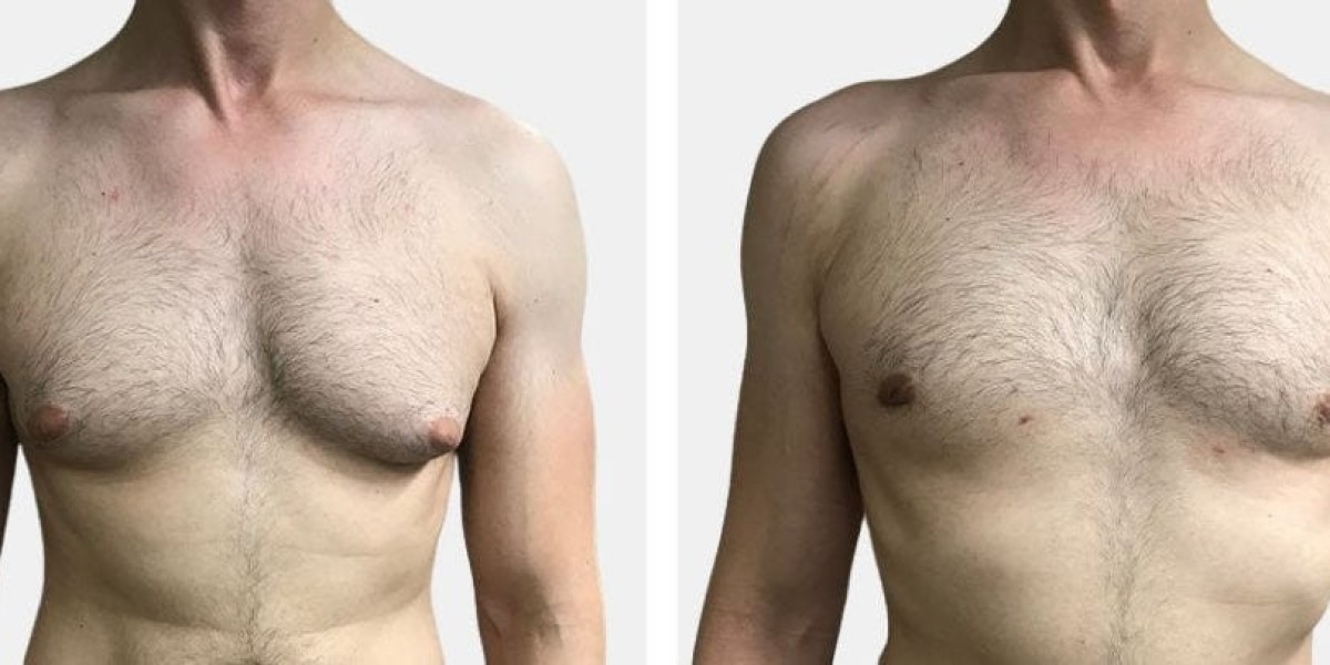 Gynaecomastia Surgery in Dubai for Chest Definition