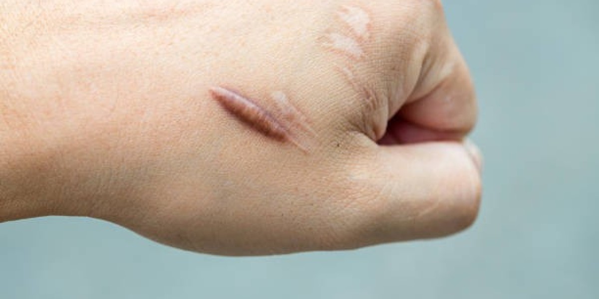 Combination Therapy Strategies for Hypertrophic Scar Treatment in Dubai