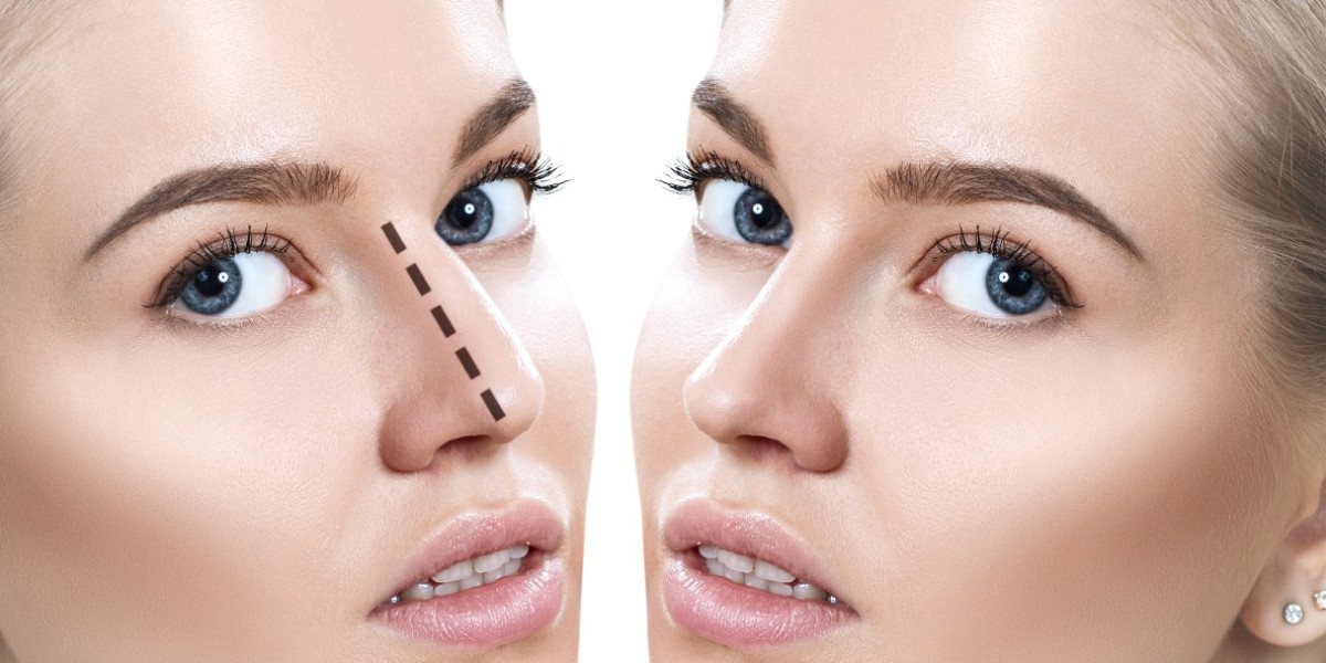 Liquid Rhinoplasty in Dubai for Aesthetic Enhancement