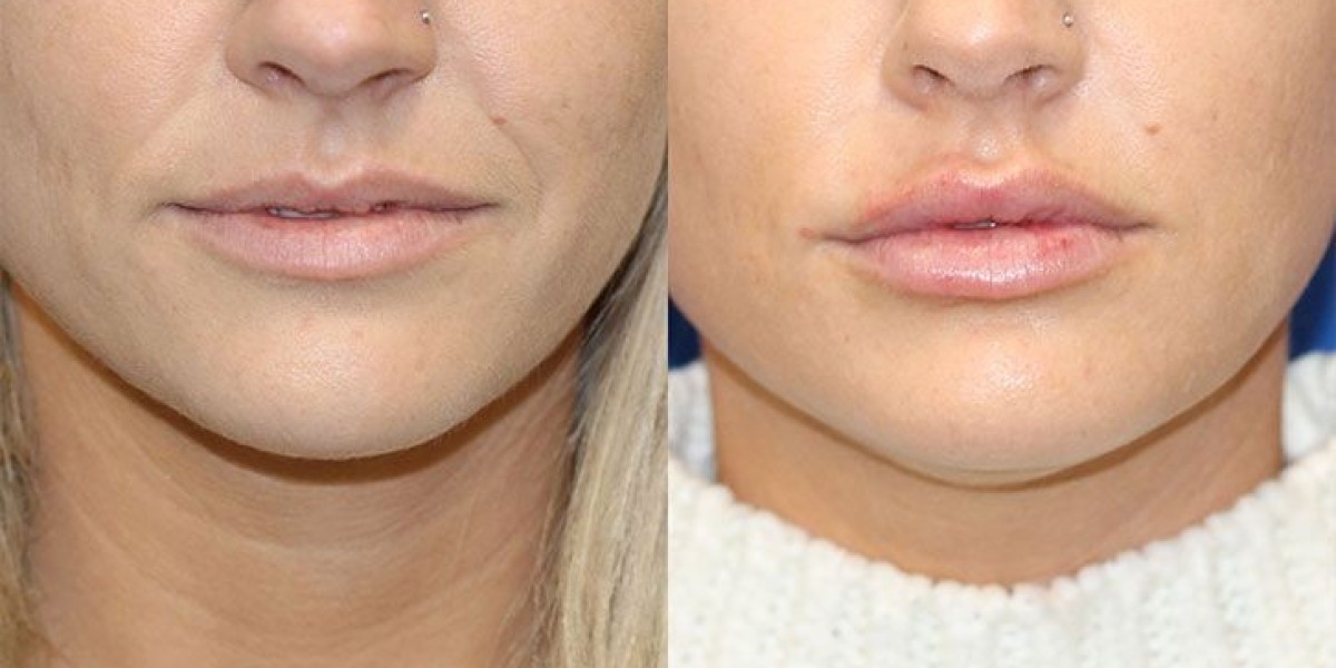 A Detailed Overview of the Lip Reduction Journey