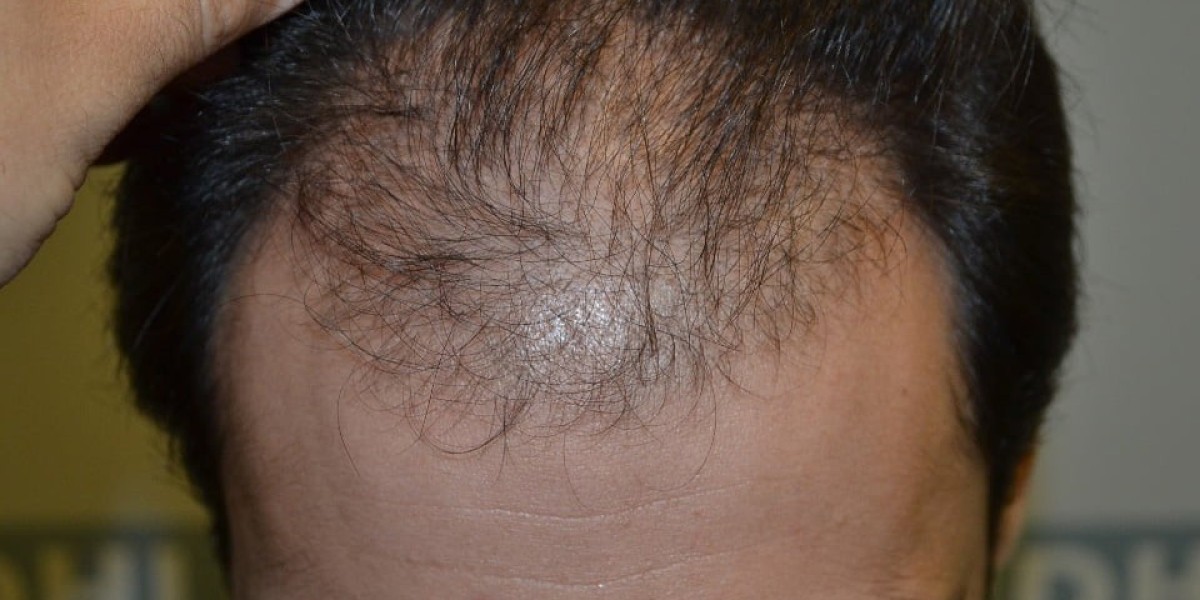 Hair Transplant in Dubai Best Practices for Results