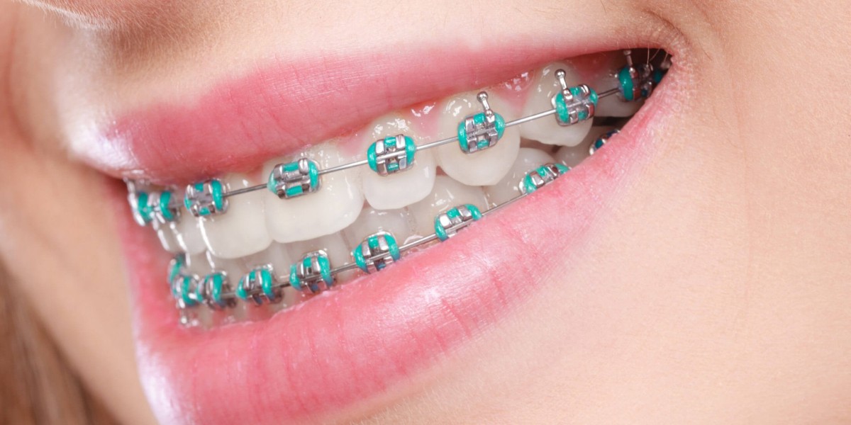 Can Adults Get Dental Braces? Everything You Need to Know