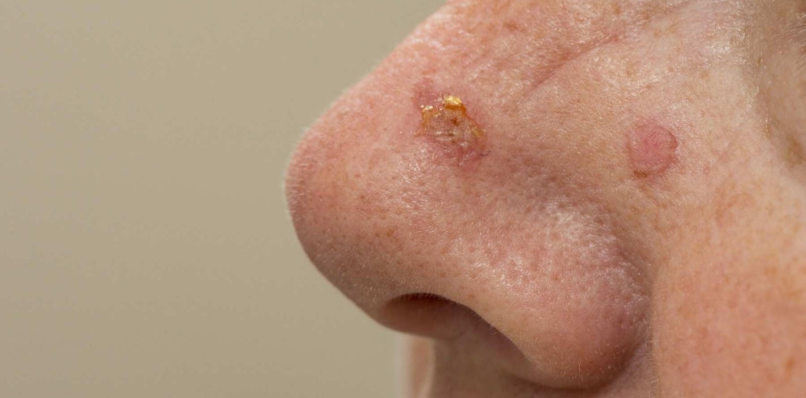 Actinic keratosis treatment in Bandra in Bandra | Bliss Skin Dental