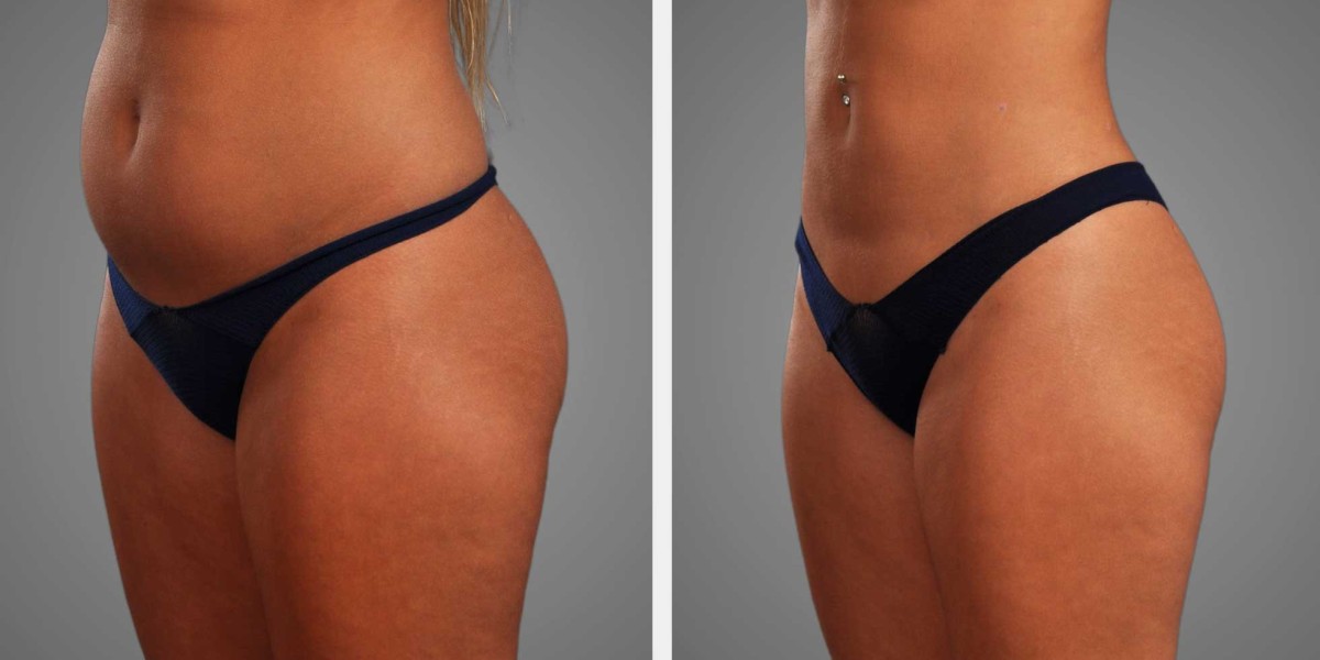 Liposuction in Islamabad and the future of personalized body sculpting