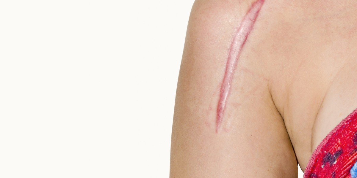 Scar Camouflage in Dubai What to Expect Process
