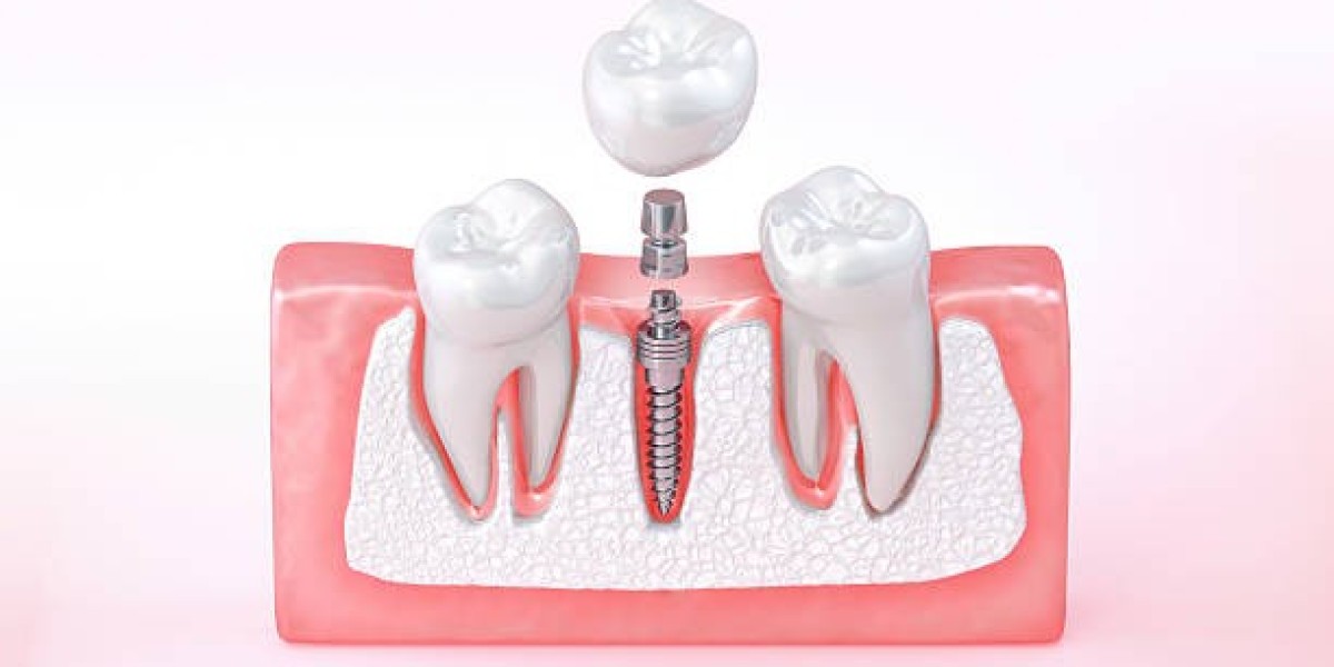 Are Dental Implants in Brisbane Worth Considering?